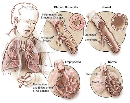 COPD