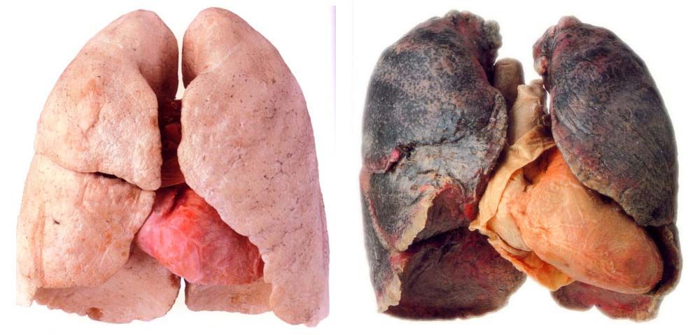 Smokers lungs