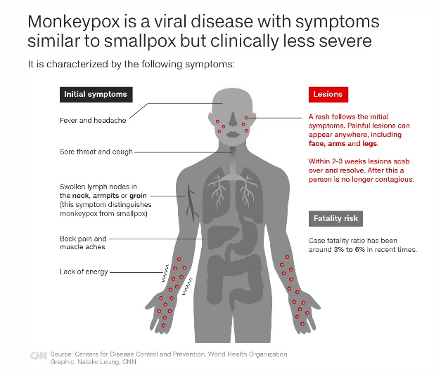 Monkeypox Symptoms