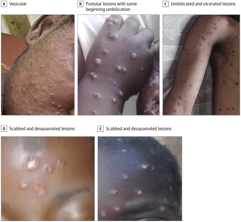 Monkeypox Rash