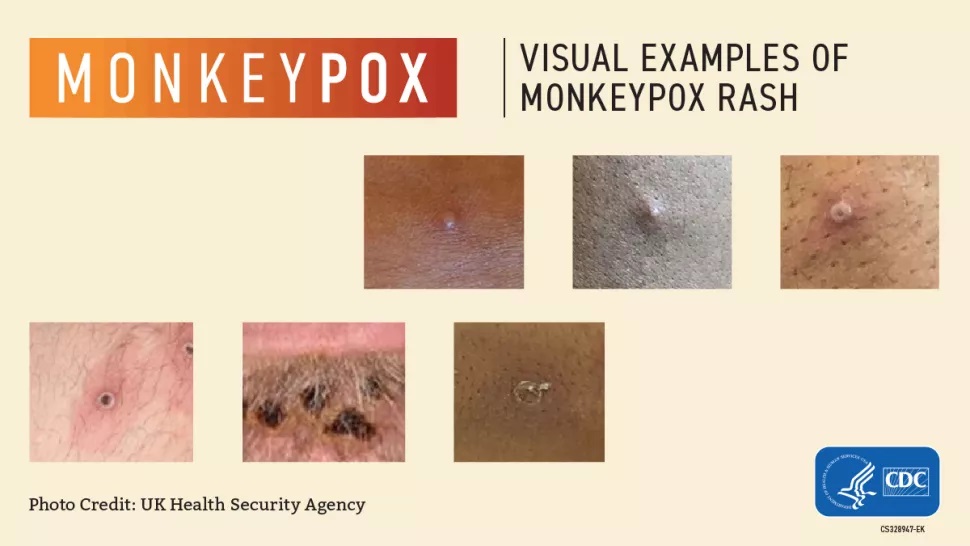 MPXV rash