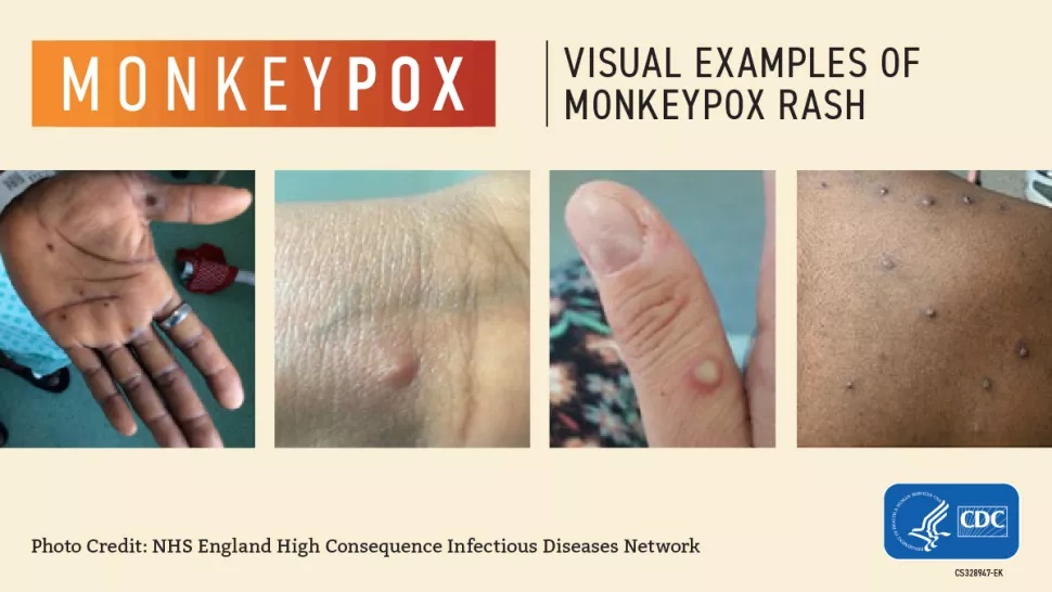 MPXV rash