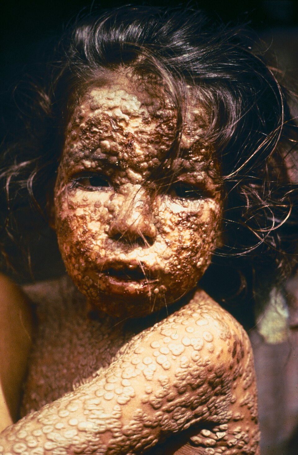 child with smallpox