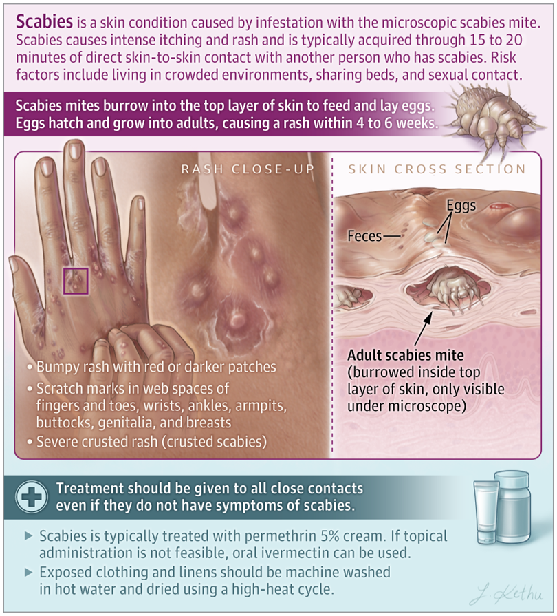 Scabies