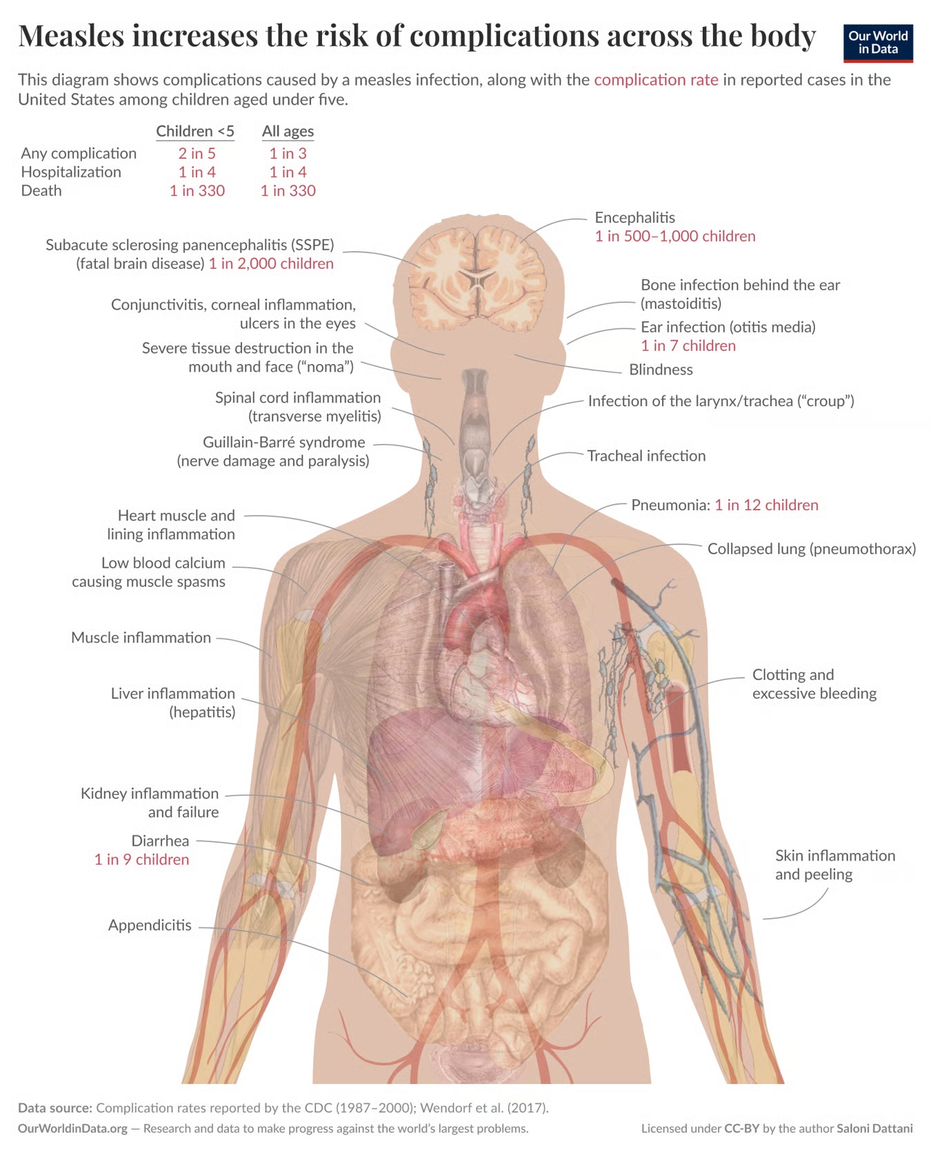 Measles complications